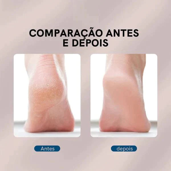 Lixa Elétrica para Calos e Rachaduras - BeautyFeet